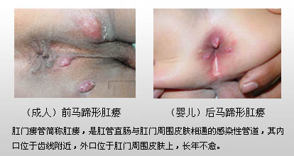 肛瘘.jpg