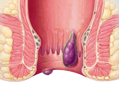 如何判断自己是否得了痔疮