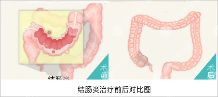 结肠炎的早期症状!