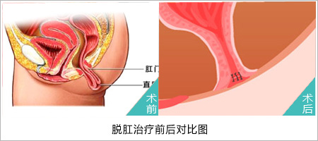 脱肛医博肛肠医院!