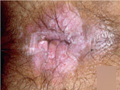 如何治疗肛门湿疹的瘙痒症状！