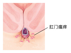 总是肛门瘙痒怎么回事？