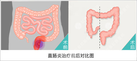 直肠炎几种常见类型？