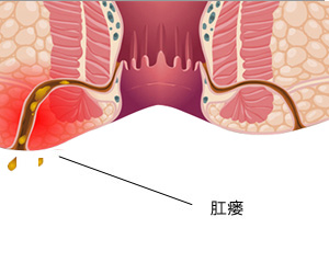 福州肛瘘手术方法好的专科医院-福州医博肛肠医院