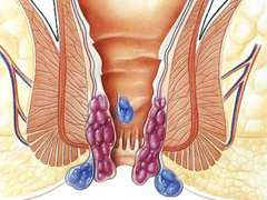 福州痔疮的原因有哪些