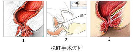 脱肛怎么办医博医院优先!