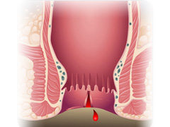 大便后脱肛怎么办？