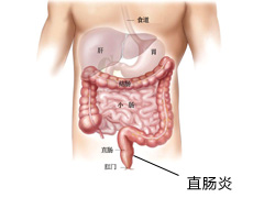 孩子患上直肠炎有哪些症状？