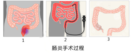 冬季警惕结肠炎的侵扰！