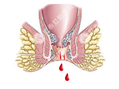 肛门疼痛便血的原因是什么