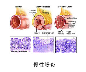 秋冬之际如何预防慢性肠炎？