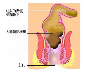 便秘怎么办？