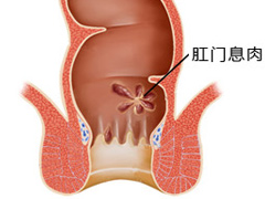 肛门息肉图片是怎么样的？福州极好的肛肠医院