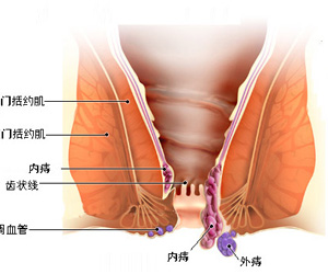 福州外痔发病原因