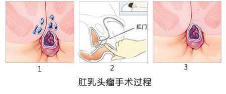 肛乳头肥大还有哪些症状？