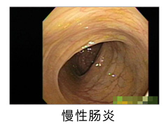 患上慢性肠炎从哪些方面可以看出来？