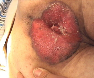 肛门湿疹的发病原因是什么-福州医博肛肠专科医院