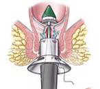 智能PPH治痔疮三步到位