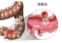 结肠炎百科