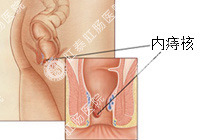 内痔百科