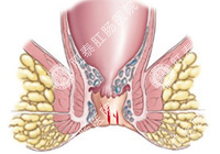 肛裂百科