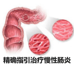 日本无痛“面条”肠镜有效指引治疗慢性