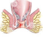 肛肠治疗方法要给力 效果才到位