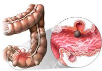 肠道疾病-典型病例