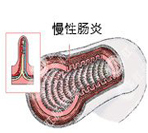 的慢性肠炎如何治疗？