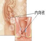 内痔便血怎么办？