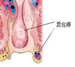 混合痔要怎么预防？