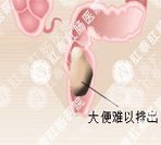 严重便秘有什么危害？