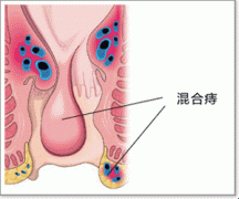 混合痔示意图