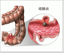 结肠炎致腹泻示意图