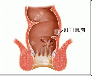 福州肛门息肉会癌变吗？