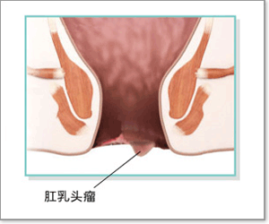 治疗肛乳头瘤