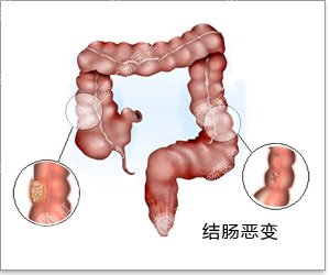 结肠恶变患者禁忌哪些行为