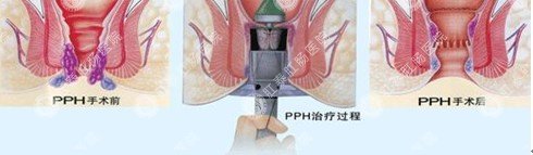 PPH创口微小手术治疗混合痔过程