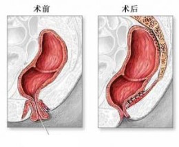 脱肛的症状