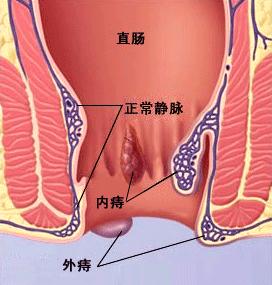 外痔、内痔和混合痔的区别