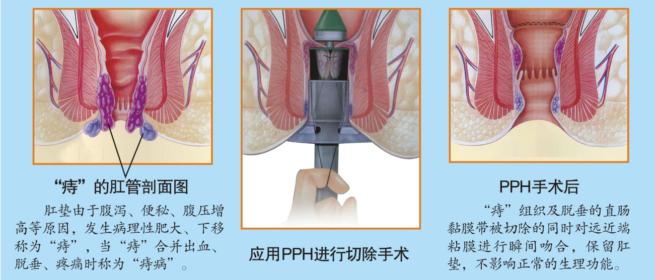 图示：混合痔脱肛要怎么治疗