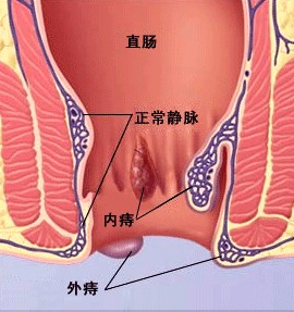 图示：混合痔便血有什么危害