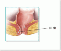 福州肛肠医院：肛瘘要如何治疗？