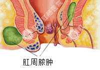肛周脓肿示意图