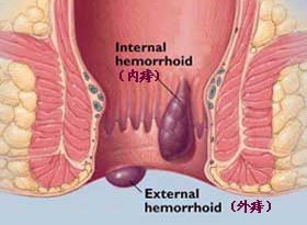 图示：混合痔