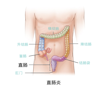 图示：直肠炎