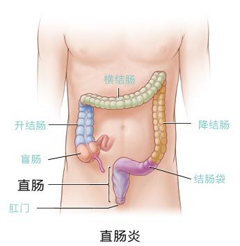 直肠炎初期有什么症状？