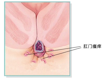 引发肛门瘙痒的病因有哪些？