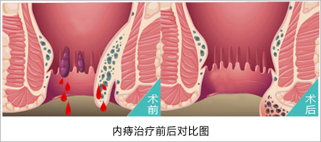 痔疮怎么治疗医博医院极专业!