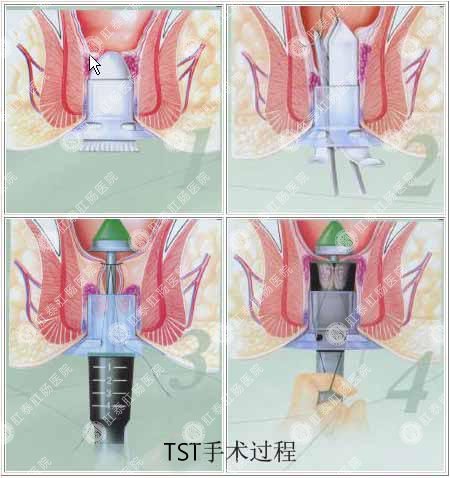 医博TST手术过程